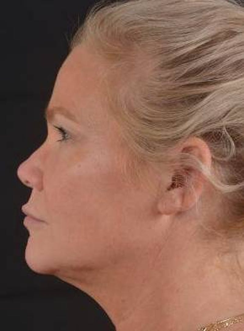 Necklift Before & After Gallery - Patient 416332 - Image 3