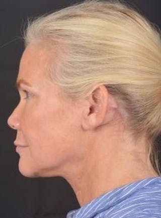 Necklift Before & After Gallery - Patient 416332 - Image 4