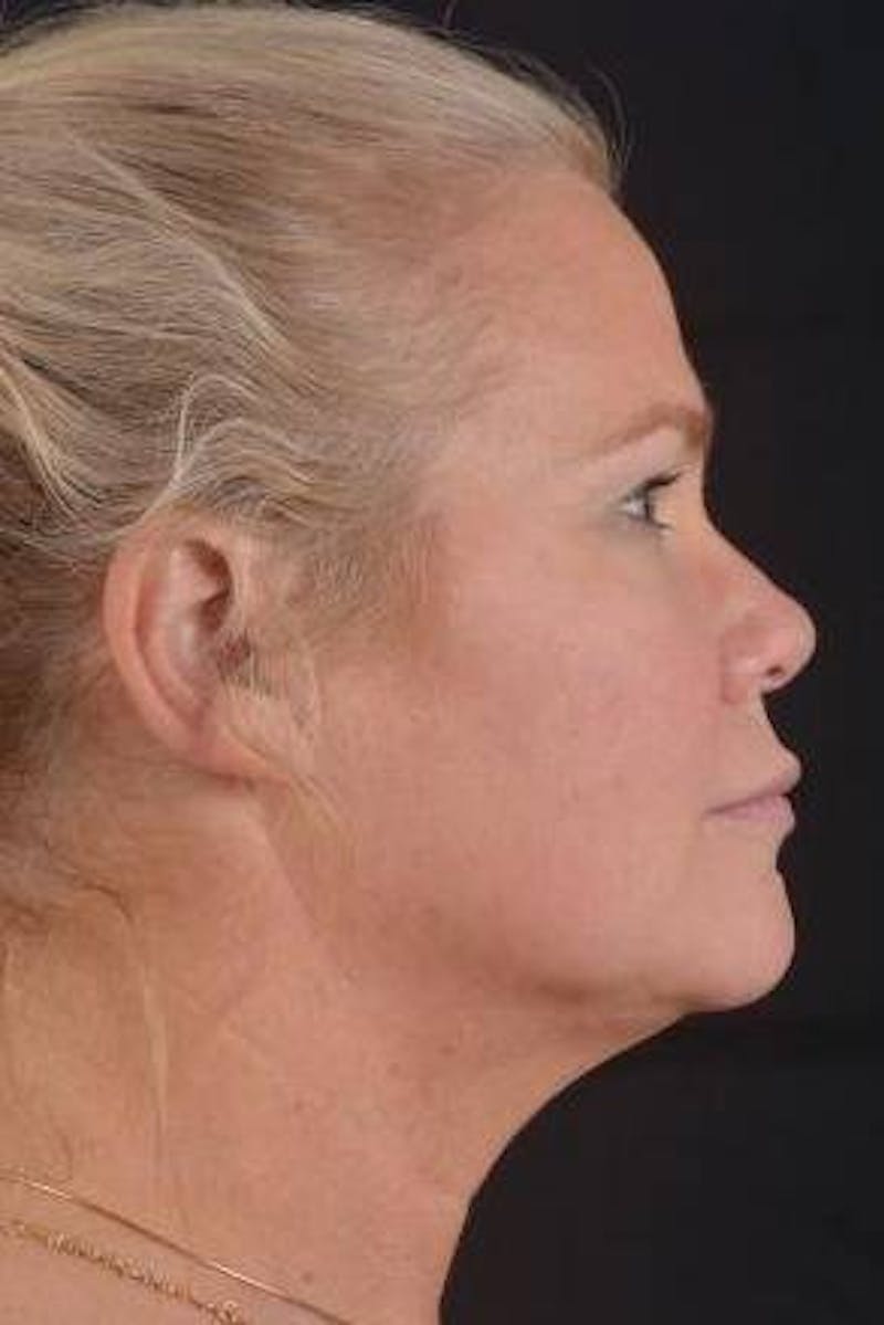 Necklift Before & After Gallery - Patient 416332 - Image 5