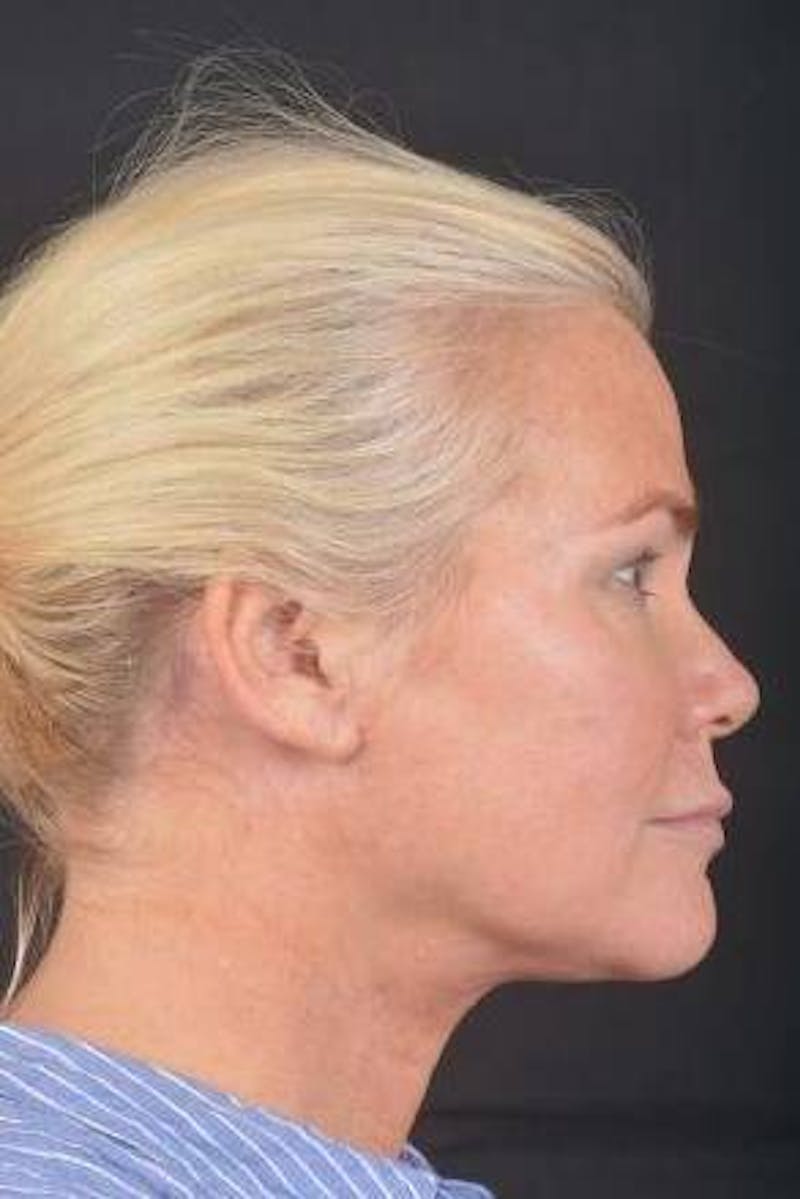 Necklift Before & After Gallery - Patient 416332 - Image 6
