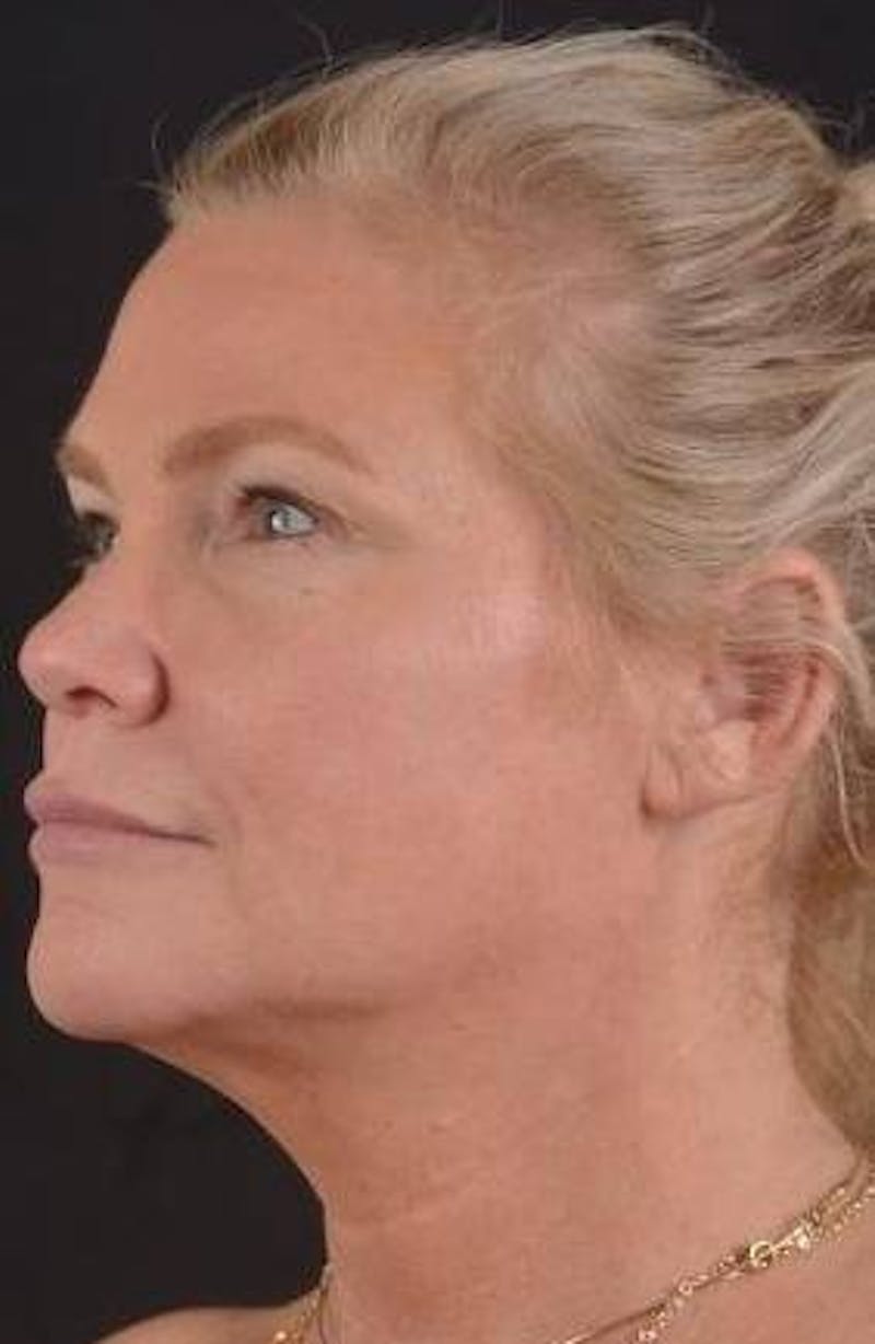 Necklift Before & After Gallery - Patient 416332 - Image 7
