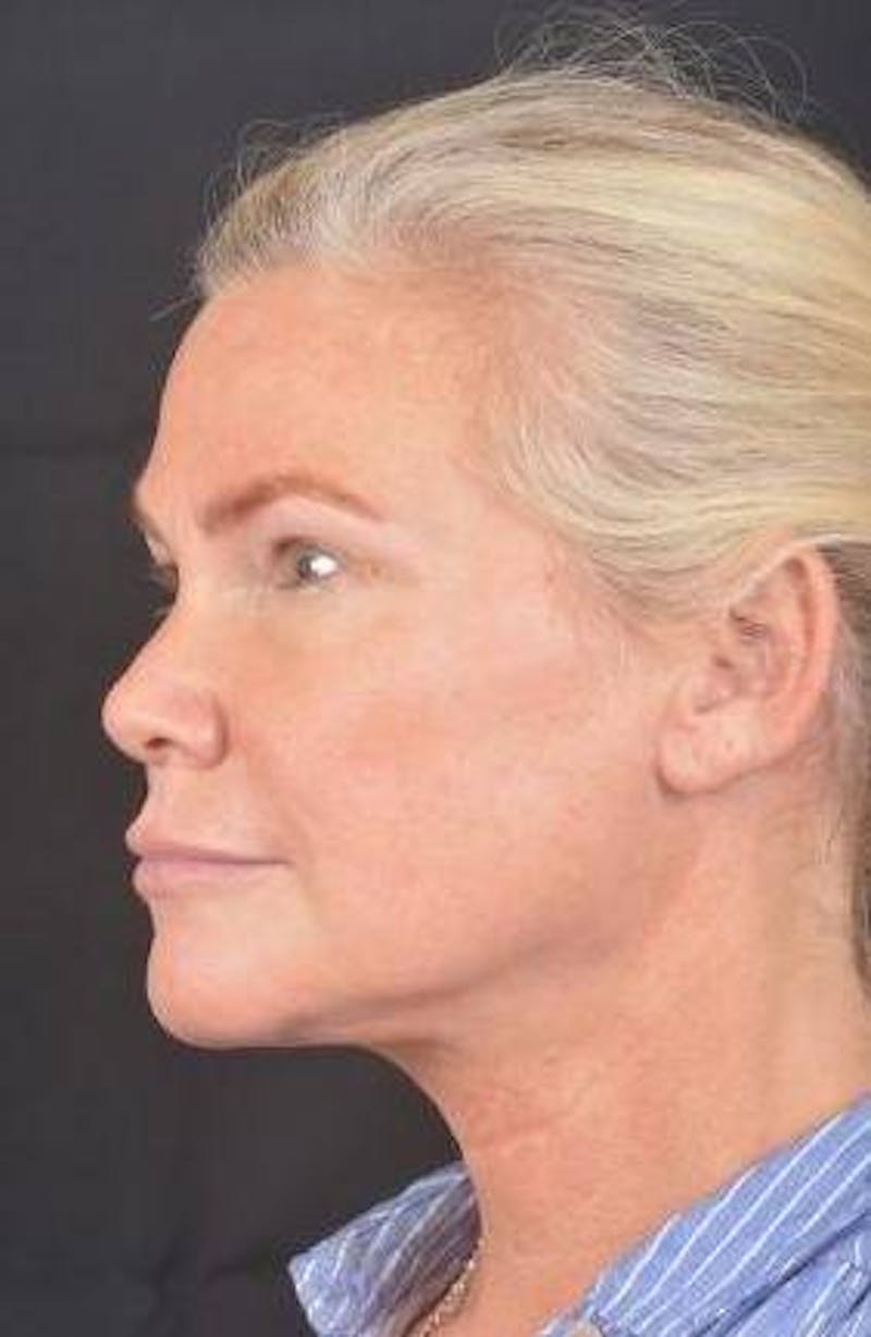 Necklift Before & After Gallery - Patient 416332 - Image 8