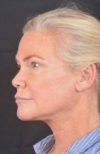 Necklift Before & After Gallery - Patient 416332 - Image 8