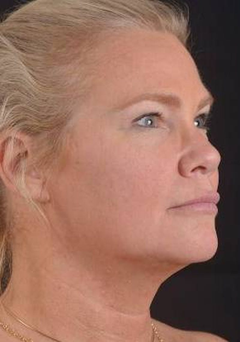 Necklift Before & After Gallery - Patient 416332 - Image 9