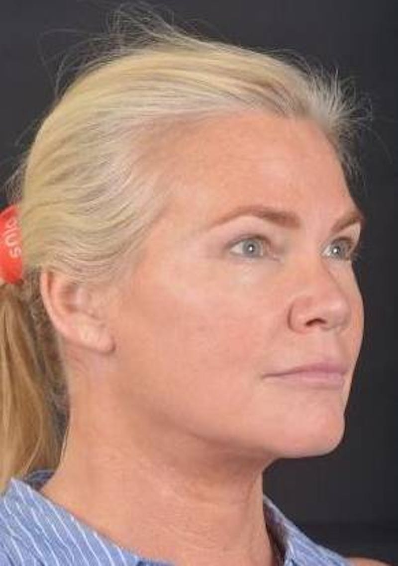 Necklift Before & After Gallery - Patient 416332 - Image 10