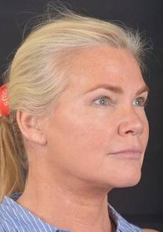 Necklift Before & After Gallery - Patient 416332 - Image 10