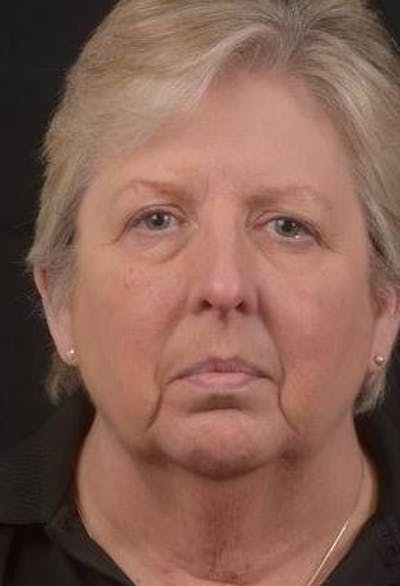 Necklift Before & After Gallery - Patient 144546 - Image 1