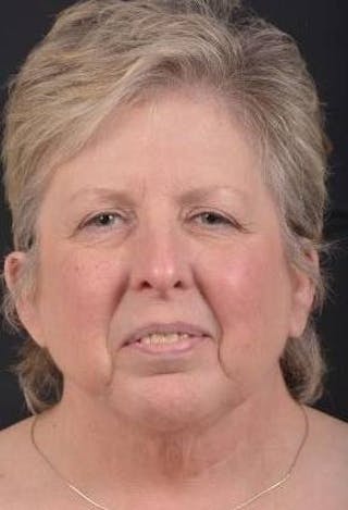 Necklift Before & After Gallery - Patient 144546 - Image 2
