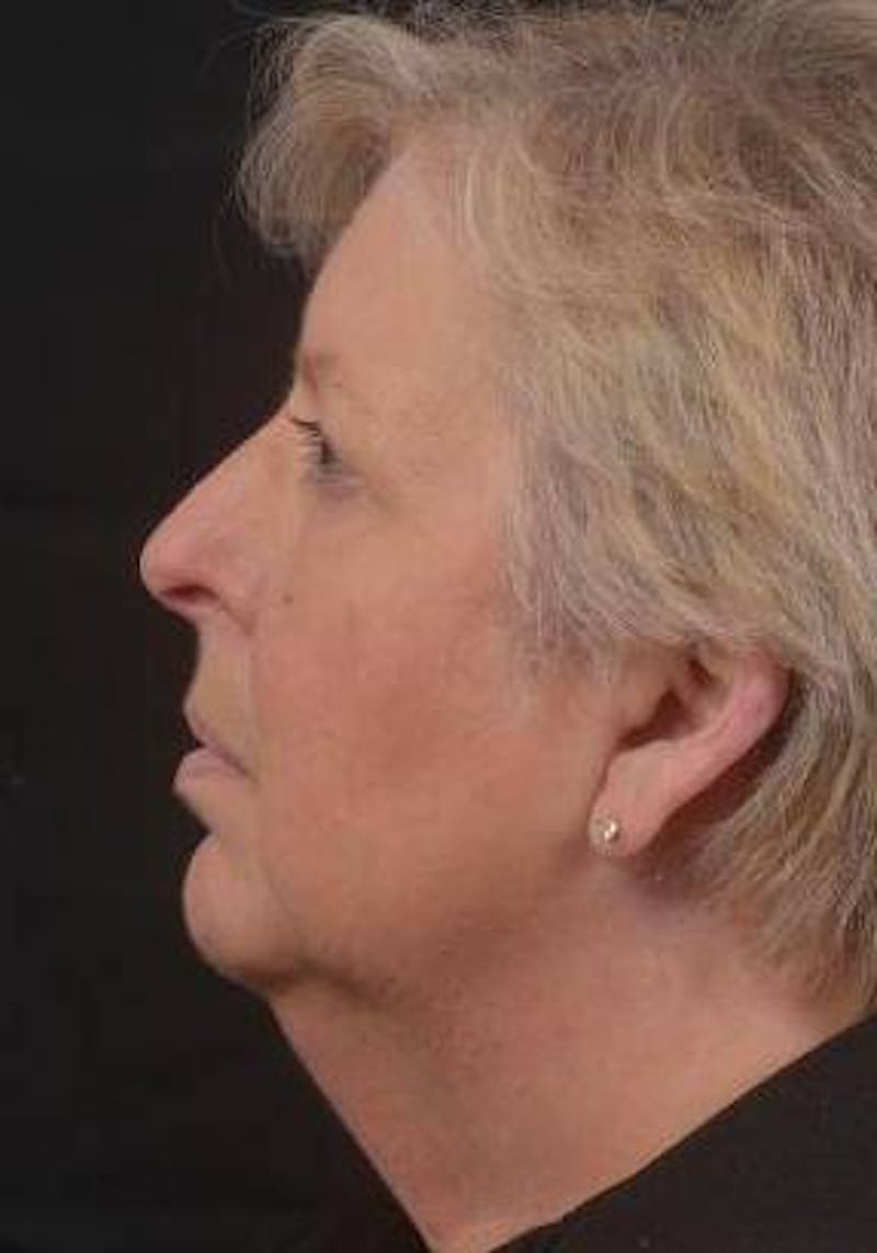 Necklift Before & After Gallery - Patient 144546 - Image 3
