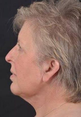 Necklift Before & After Gallery - Patient 144546 - Image 4