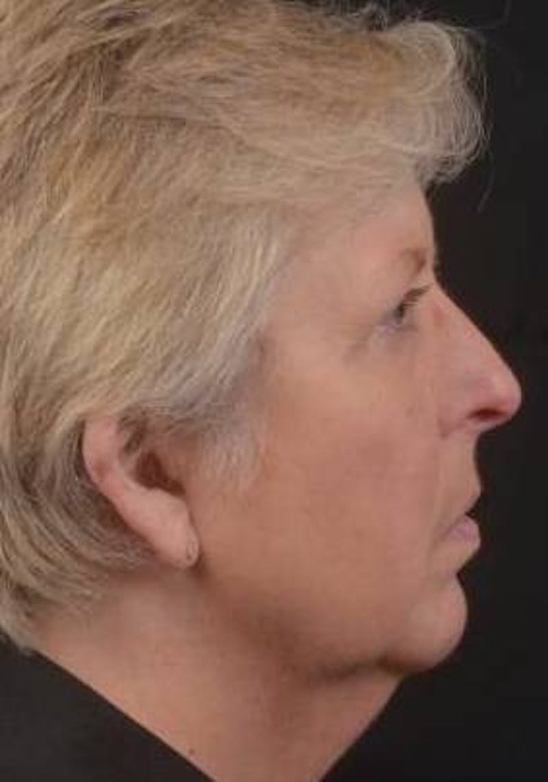 Necklift Before & After Gallery - Patient 144546 - Image 5