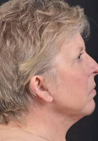 Necklift Before & After Gallery - Patient 144546 - Image 6