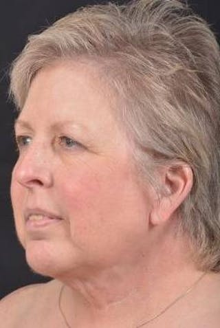 Necklift Before & After Gallery - Patient 144546 - Image 8