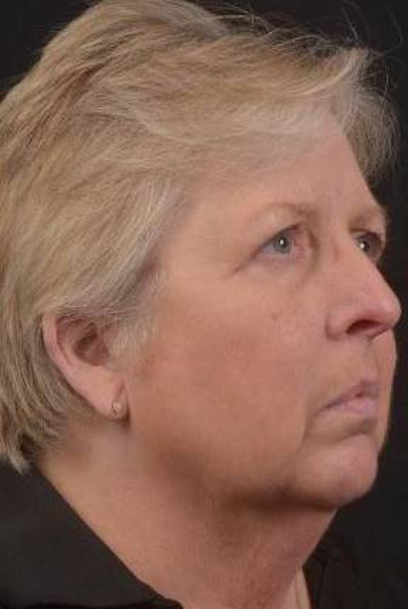 Necklift Before & After Gallery - Patient 144546 - Image 9