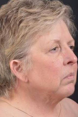 Necklift Before & After Gallery - Patient 144546 - Image 10