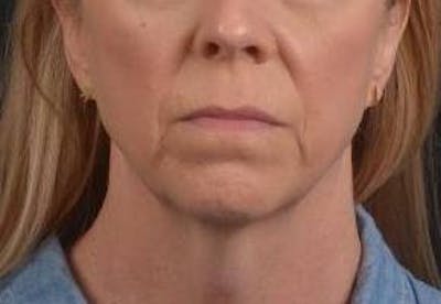 Necklift Before & After Gallery - Patient 115178 - Image 1