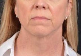 Necklift Before & After Gallery - Patient 115178 - Image 2