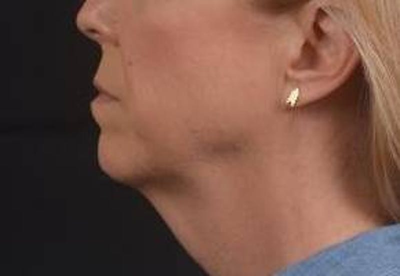Necklift Before & After Gallery - Patient 115178 - Image 3