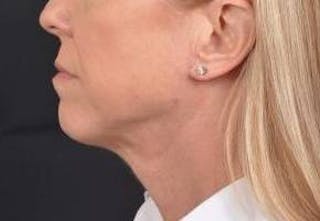 Necklift Before & After Gallery - Patient 115178 - Image 4