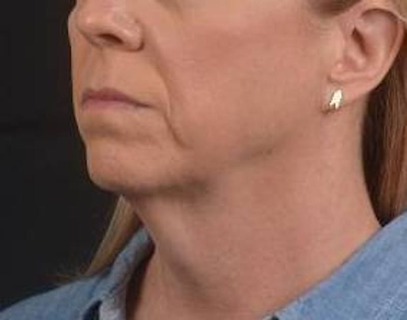 Necklift Before & After Gallery - Patient 115178 - Image 7