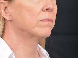 Necklift Before & After Gallery - Patient 115178 - Image 10