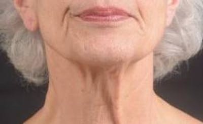 Necklift Before & After Gallery - Patient 420798 - Image 1