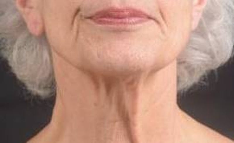 Necklift Before & After Gallery - Patient 420798 - Image 1