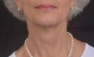 Necklift Before & After Gallery - Patient 420798 - Image 2