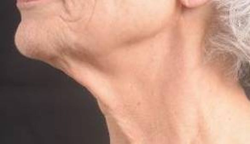 Necklift Before & After Gallery - Patient 420798 - Image 7