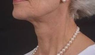 Necklift Before & After Gallery - Patient 420798 - Image 8