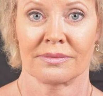 Necklift Before & After Gallery - Patient 409252 - Image 1