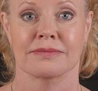 Necklift Before & After Gallery - Patient 409252 - Image 2