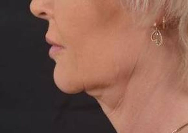 Necklift Before & After Gallery - Patient 409252 - Image 3