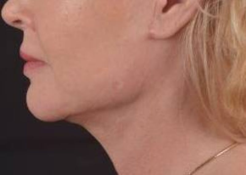 Necklift Before & After Gallery - Patient 409252 - Image 4