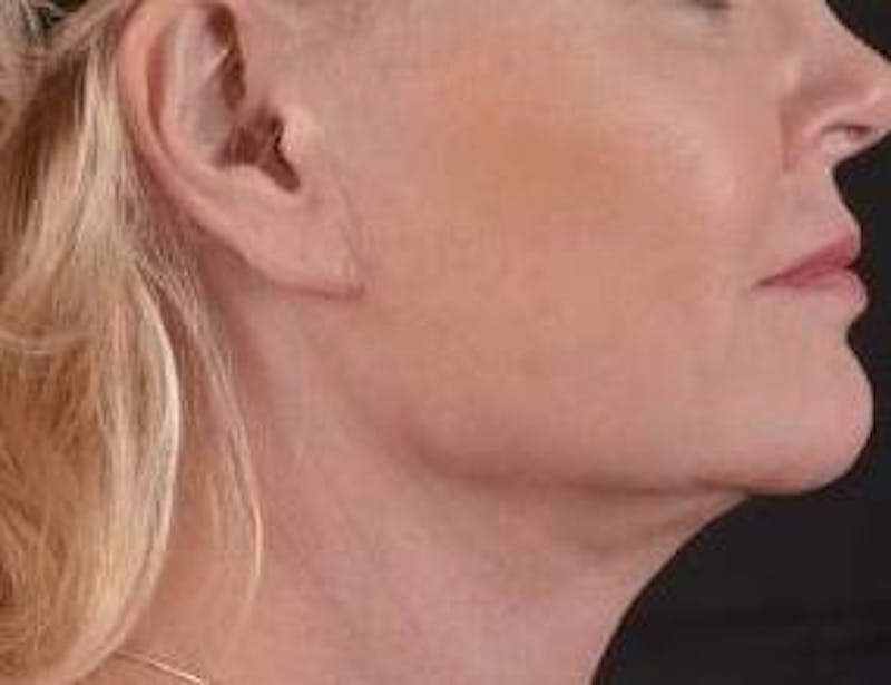 Necklift Before & After Gallery - Patient 409252 - Image 6