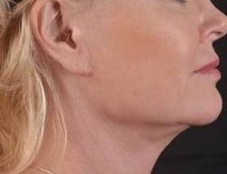 Necklift Before & After Gallery - Patient 409252 - Image 6