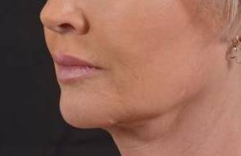 Necklift Before & After Gallery - Patient 409252 - Image 7