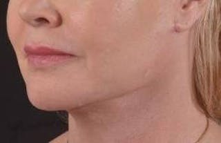 Necklift Before & After Gallery - Patient 409252 - Image 8