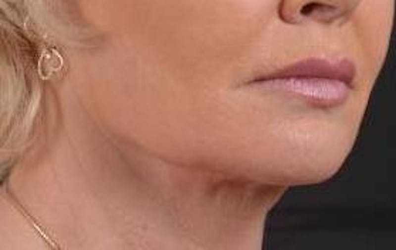 Necklift Before & After Gallery - Patient 409252 - Image 9