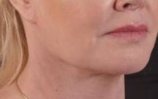 Necklift Before & After Gallery - Patient 409252 - Image 10