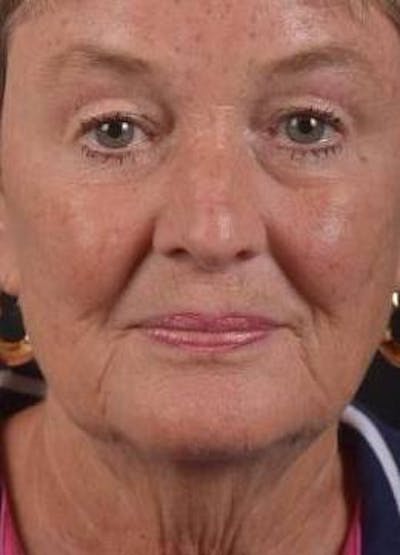 Necklift Before & After Gallery - Patient 106708 - Image 1