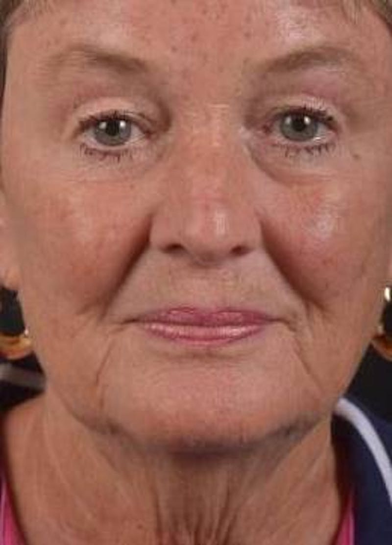 Necklift Before & After Gallery - Patient 106708 - Image 1