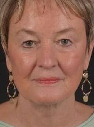 Necklift Before & After Gallery - Patient 106708 - Image 2