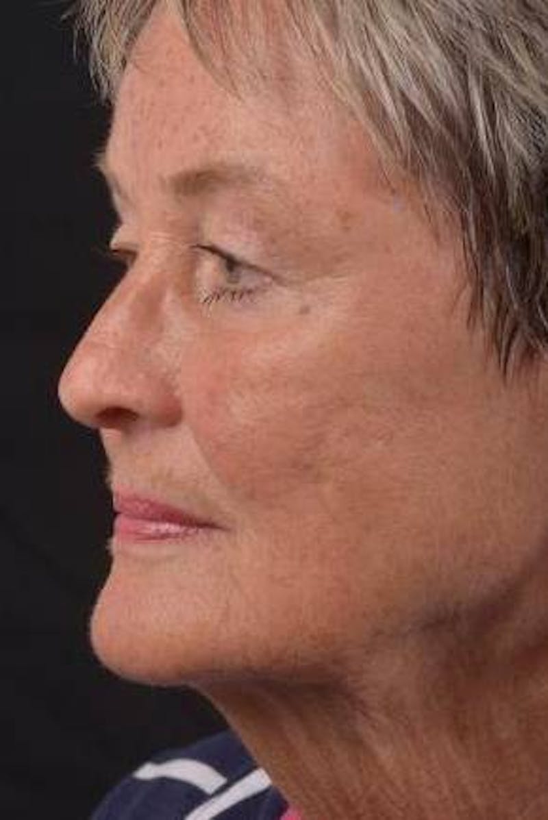 Necklift Before & After Gallery - Patient 106708 - Image 3