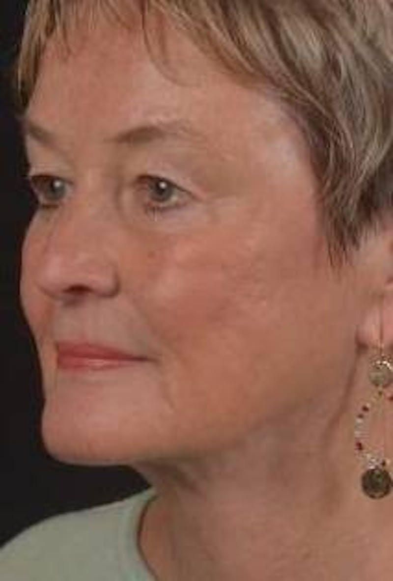 Necklift Before & After Gallery - Patient 106708 - Image 4