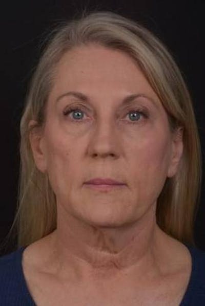 Necklift Before & After Gallery - Patient 312086 - Image 1