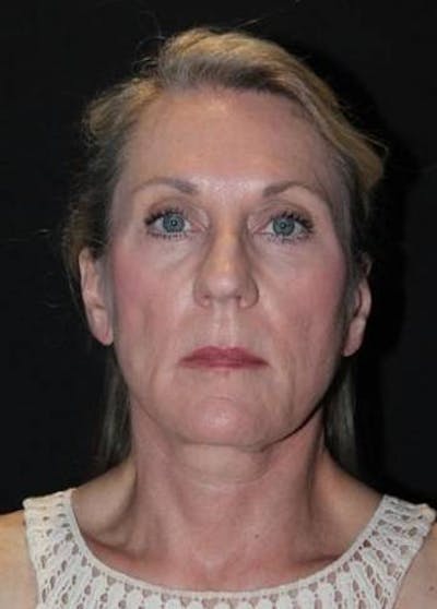 Necklift Before & After Gallery - Patient 312086 - Image 2
