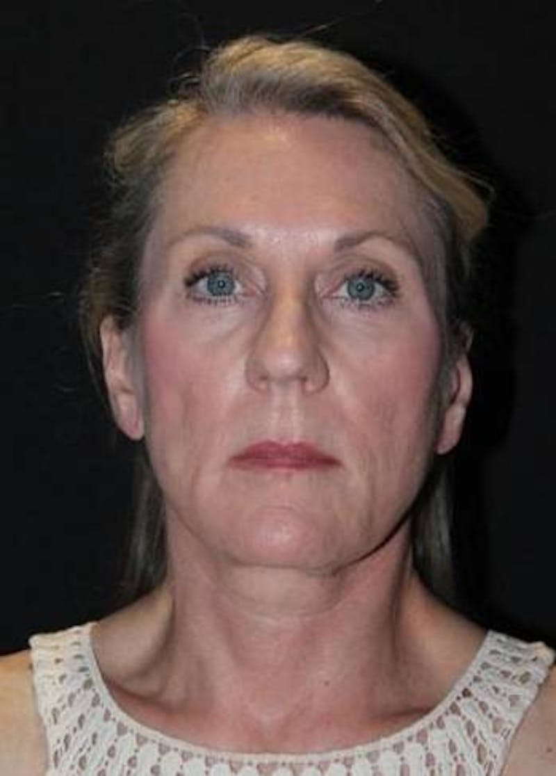Necklift Before & After Gallery - Patient 312086 - Image 2