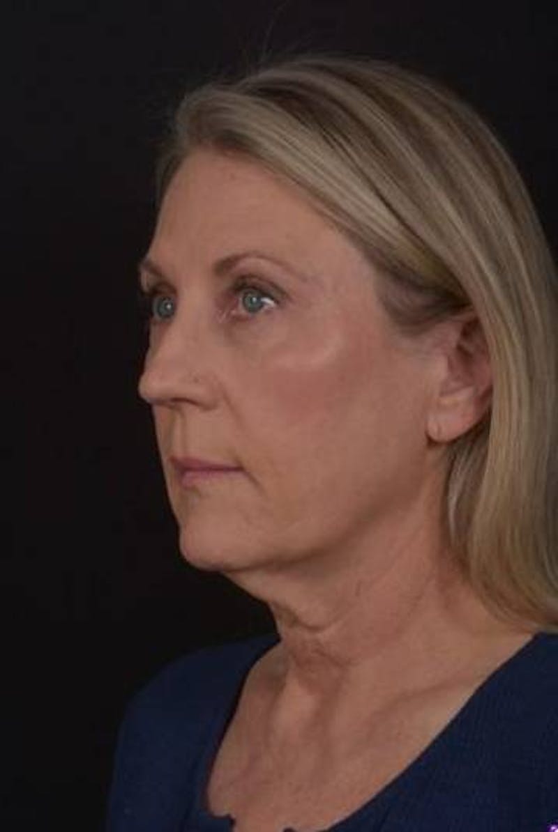 Necklift Before & After Gallery - Patient 312086 - Image 3