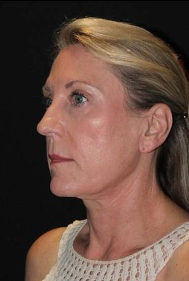 Necklift Before & After Gallery - Patient 312086 - Image 4